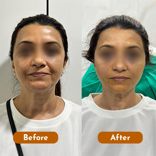 Threadlift