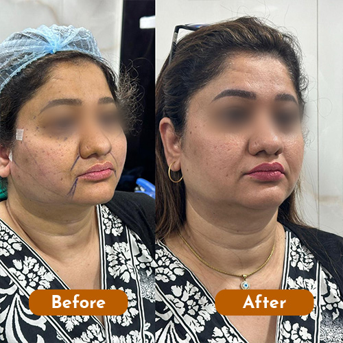 Threadlift