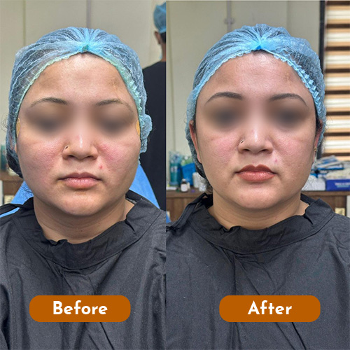 Threadlift
