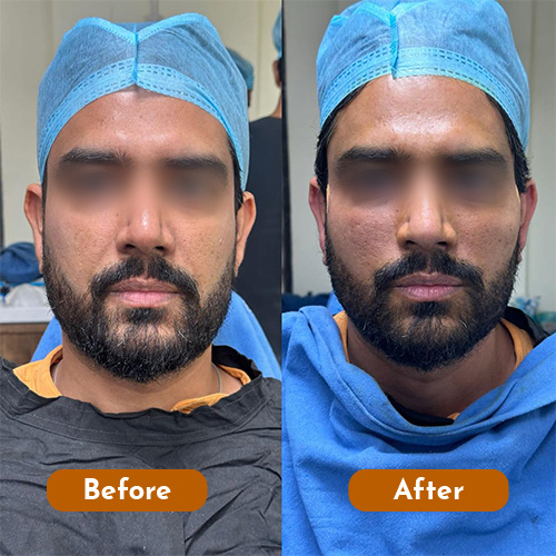 Threadlift